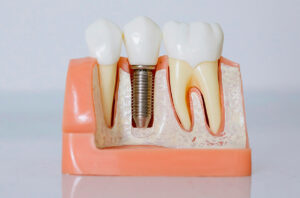 Exploring Dental Implant Options: Materials and Brands