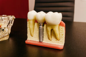 What are the Benefits of Getting Dental Implants Abroad?