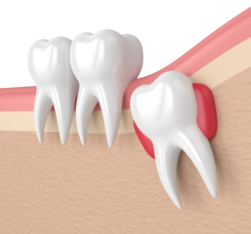 Illustration of Wisdom teeth extraction, part of our dental procedures catalog