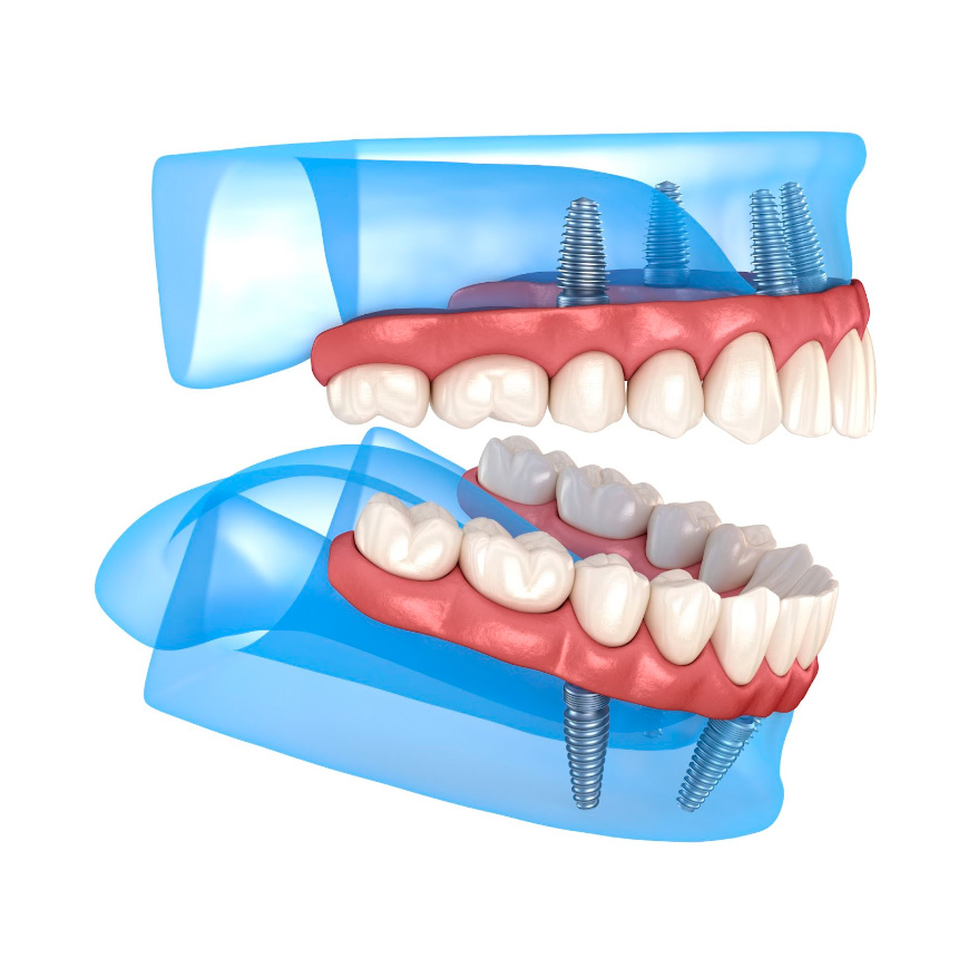 all on four implants is also one of the dental procedures we offer.