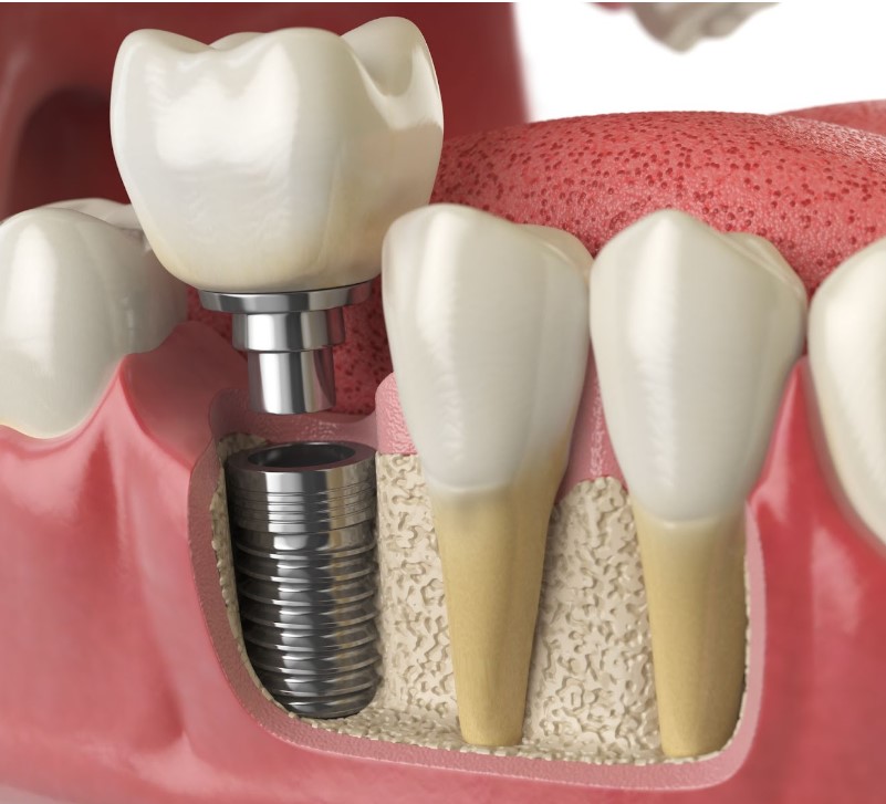 Dental implants