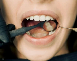 Understand veneers and care for your natural teeth