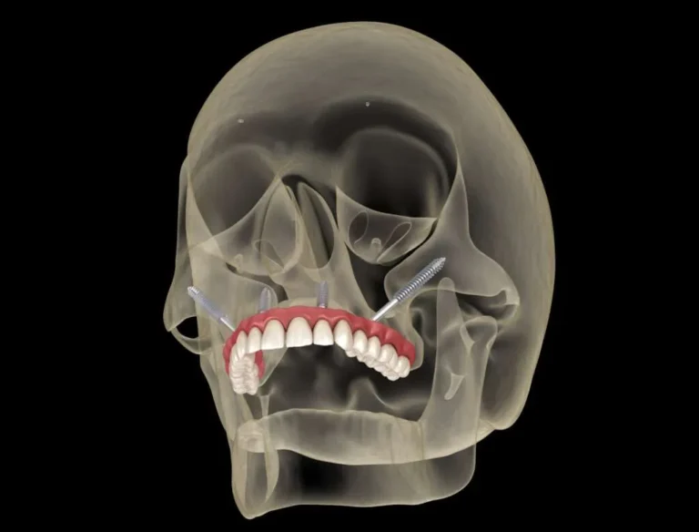 Understanding Zygomatic Implants: A Dental Revolution