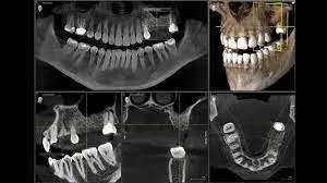 CBCT Dental Scan