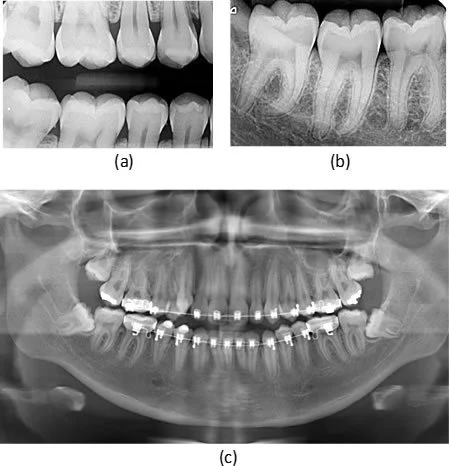 Types of X-ray images: (a) Bitewing X-ray; (b) Periapical X-ray; (c) Panoramic X-ray.