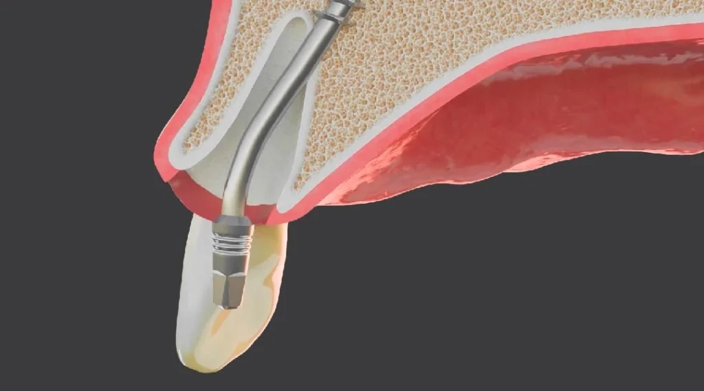 traditional biphasic vs corticobasal implants